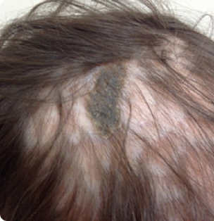 Фото атопического дерматита волосистой части головы