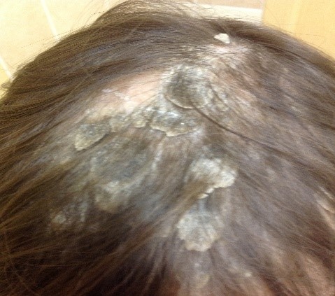 Фото атопического дерматита, плотные толстые корки на волосистой коже головы