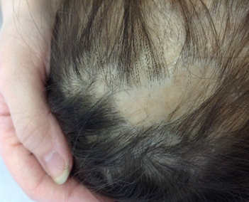 Фото атопического дерматита, на волосистой коже головы проши корки