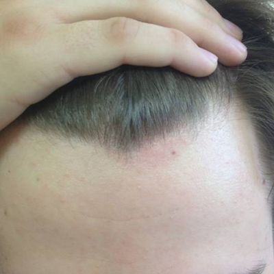 Фото вульгарного псориаза на голове в процессе лечения