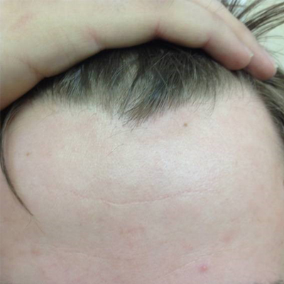 Фото вульгарного псориаза на голове по зпавершению основного лечения