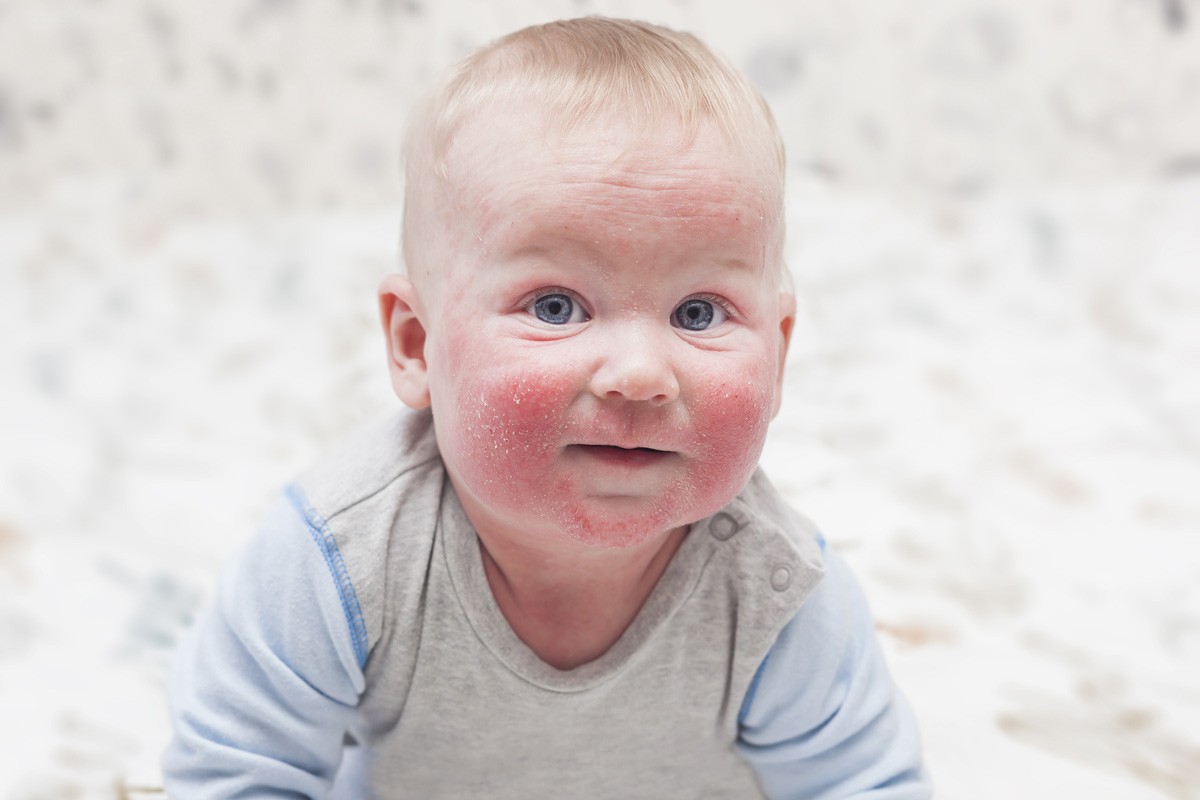 Атопический дерматит на лице у ребенка фото