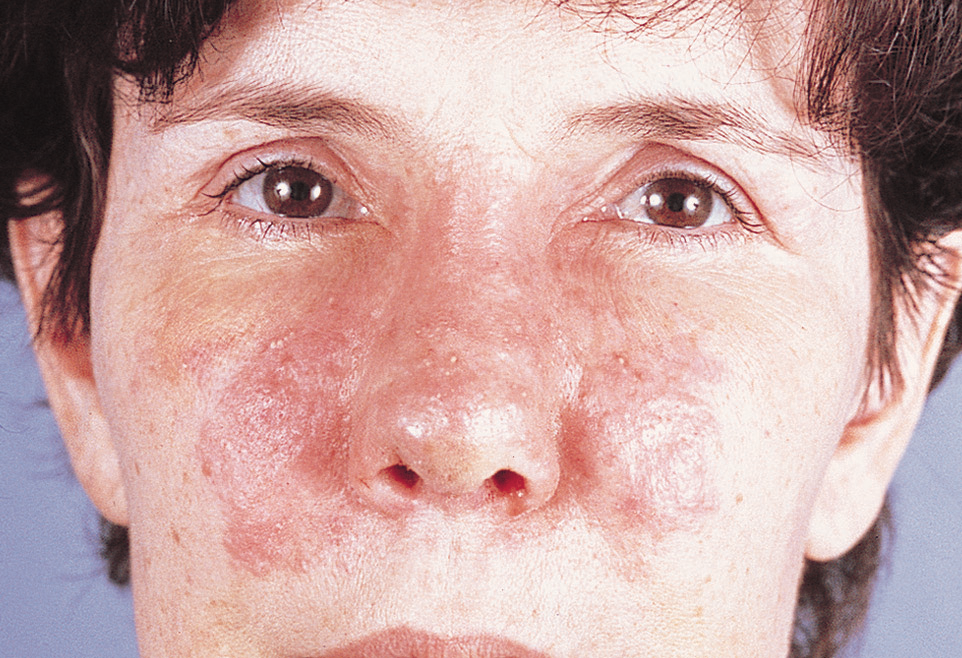 атопический дерматит на лице фото
