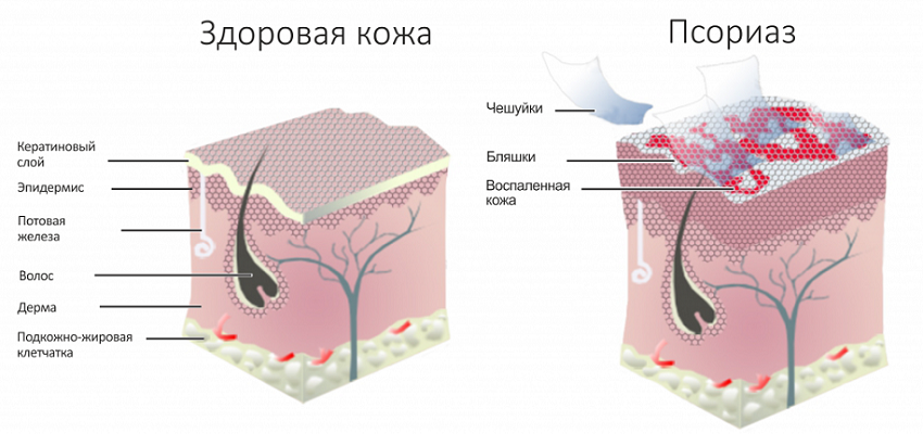 что значит стационарная стадия псориаза. Смотреть фото что значит стационарная стадия псориаза. Смотреть картинку что значит стационарная стадия псориаза. Картинка про что значит стационарная стадия псориаза. Фото что значит стационарная стадия псориаза