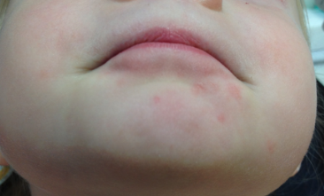 Контактный аллергический дерматит в условиях пандемии COVID-19 Картинка 1